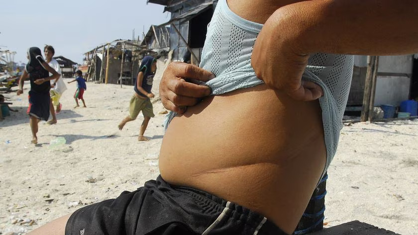 Joey Rosco, a 38 year-old father of five, shows the scar from the removal of one of his kidneys.(Jes Aznar: AFP). Photo by abc.net